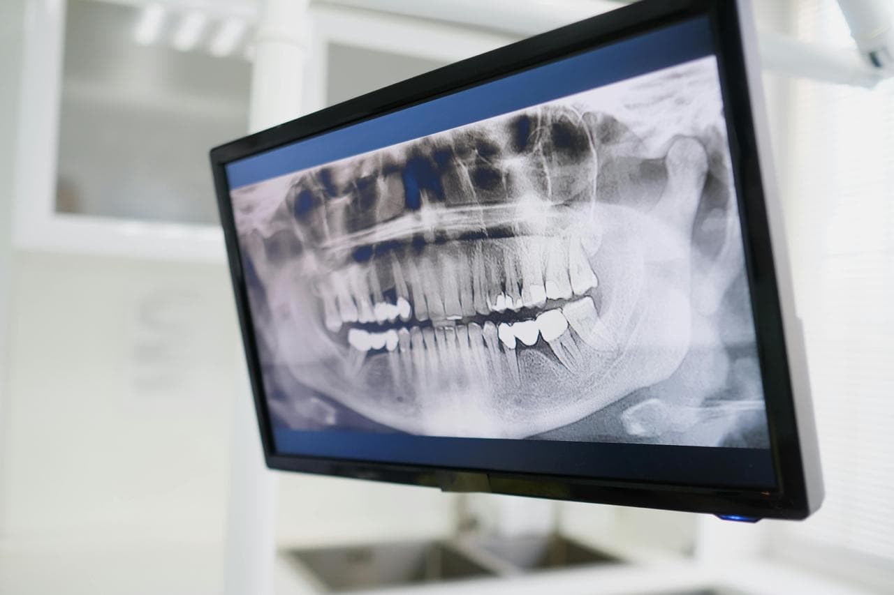 Panoramic dental X-ray displayed on a monitor at The Smile Suite